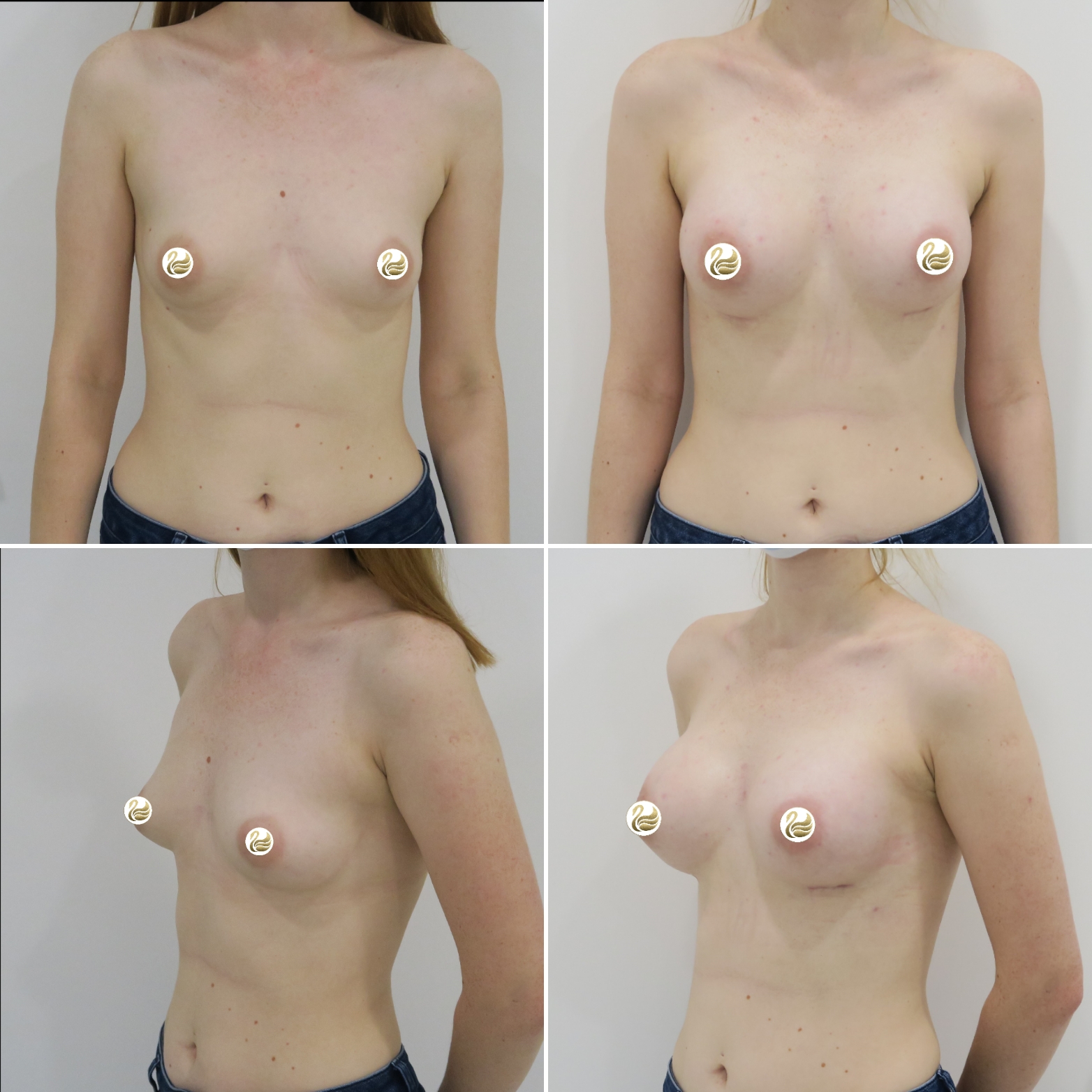 Przed: Powiększanie piersi 285ml