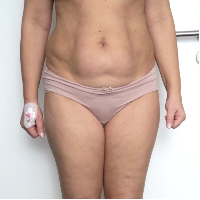 Przed: Liposukcja boczków, brzucha, bioder, ud, łydek
